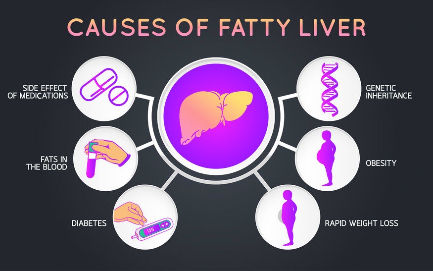 Obesity, Diabetes and Non-Alcoholic Fatty Liver Disease